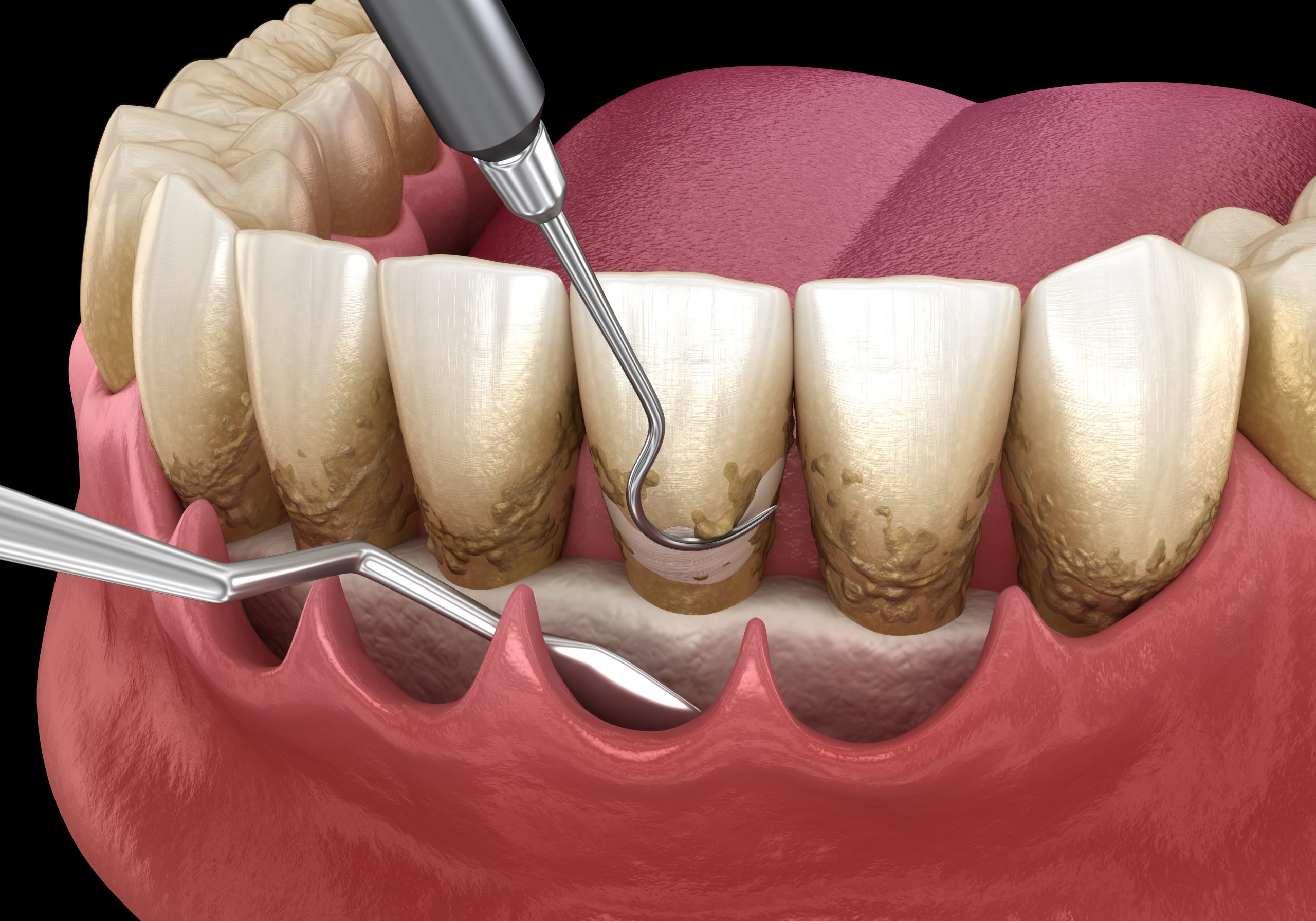 Open curettage: Scaling and root planing (conventional periodontal therapy). Medically accurate 3D illustration of human teeth treatment