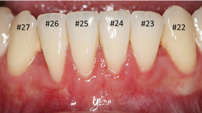 GG3-After GG3-After