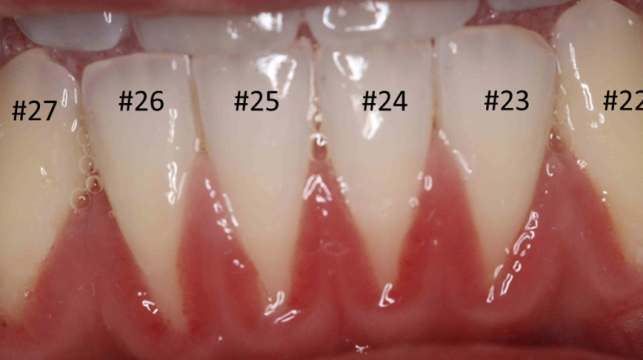 GG3-Before GG3-Before